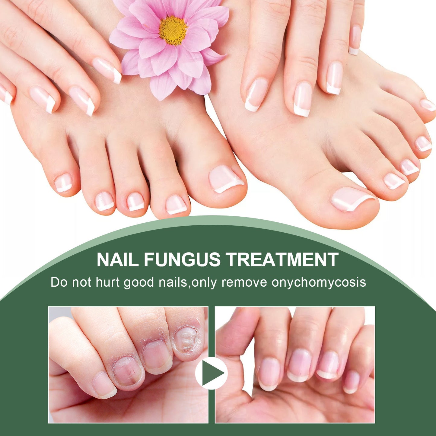 Foot Care Solution Onychomycosis Nail Care Solution